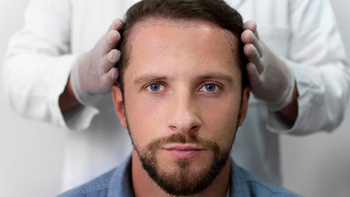 Breaking Down Types of Hair Transplant Techniques: FUT, FUE, DHI, & MHI Explained by Dr. Amit Agarkar
